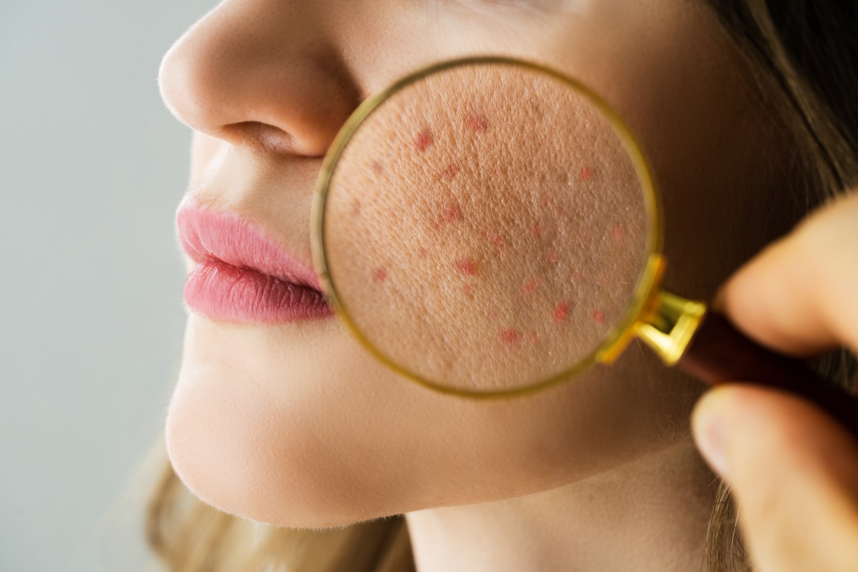 Examining Skin Acne Problems